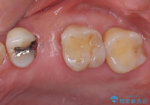 手術が怖くて抜いたままの奥歯に歯を 1DAYインプラント治療の症例 治療前