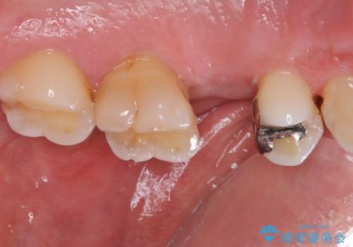 手術が怖くて抜いたままの奥歯に歯を 1DAYインプラント治療の治療前