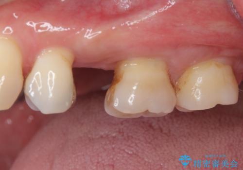 手術が怖くて抜いたままの奥歯に歯を 1DAYインプラント治療の治療前