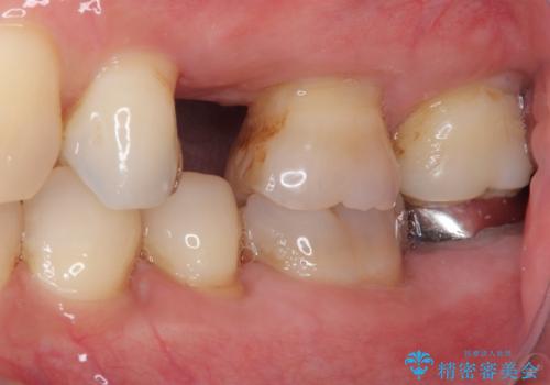 手術が怖くて抜いたままの奥歯に歯を 1DAYインプラント治療の治療前