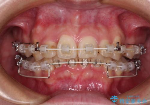 【モニター】デコボコ前歯を治したい ワイヤー装置での抜歯矯正治療の治療中