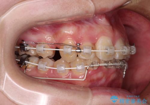 【モニター】デコボコ前歯を治したい ワイヤー装置での抜歯矯正治療の治療中