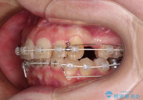 【モニター】デコボコ前歯を治したい ワイヤー装置での抜歯矯正治療の治療中