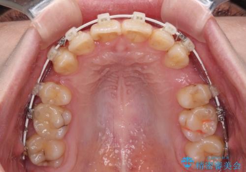 【モニター】デコボコ前歯を治したい ワイヤー装置での抜歯矯正治療の治療中
