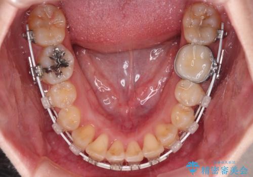【モニター】デコボコ前歯を治したい ワイヤー装置での抜歯矯正治療の治療中