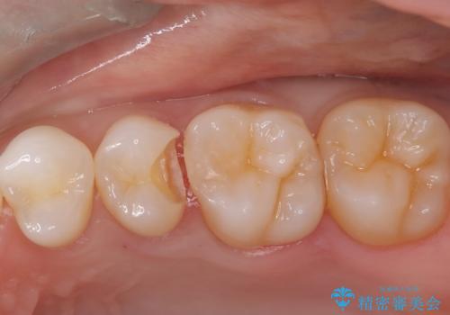 セラミックインレー 虫歯の治療の治療中