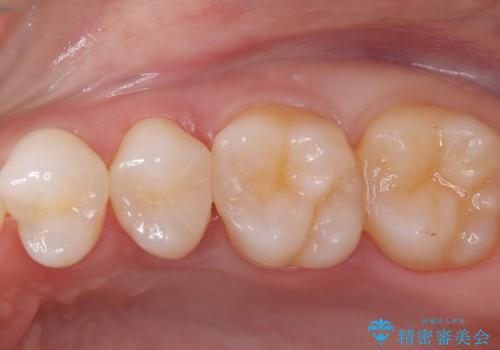 セラミックインレー 虫歯の治療