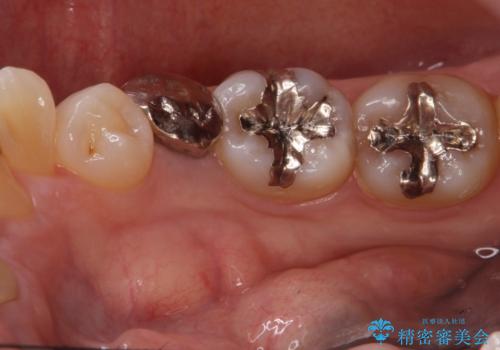 骨隆起の切除の治療前