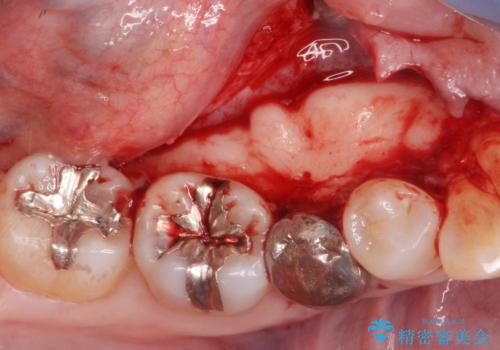 骨隆起の切除の治療前