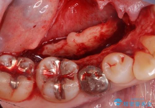 骨隆起の切除の治療中