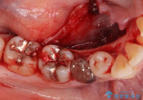 骨隆起の切除の治療後