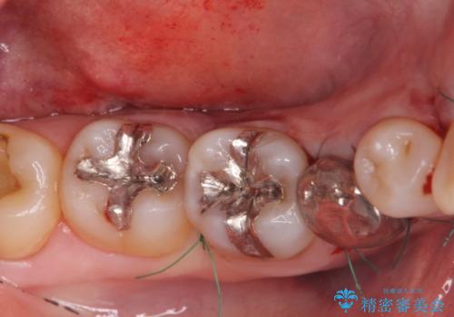 骨隆起の切除の治療中