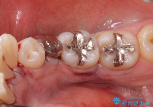 骨隆起の切除の治療中