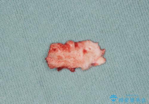 骨隆起の切除の治療中