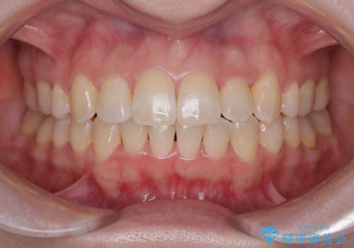 八重歯が気になる。補助装置を併用したワイヤー矯正の症例 治療後