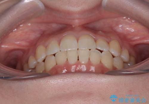 八重歯が気になる。補助装置を併用したワイヤー矯正の治療後