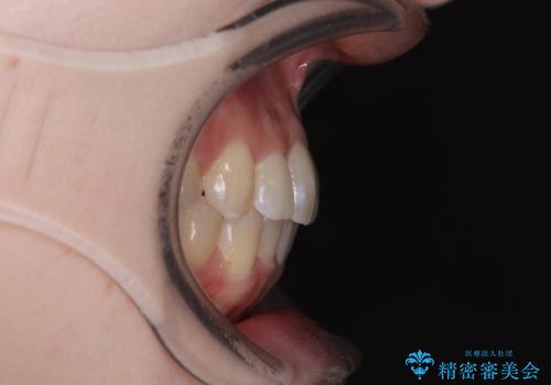 八重歯が気になる。補助装置を併用したワイヤー矯正の治療後