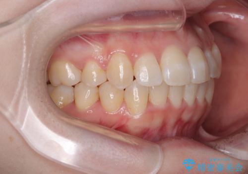 八重歯が気になる。補助装置を併用したワイヤー矯正の治療後