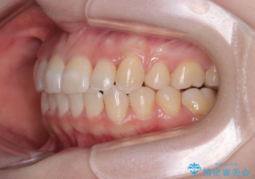 八重歯が気になる。補助装置を併用したワイヤー矯正の治療後