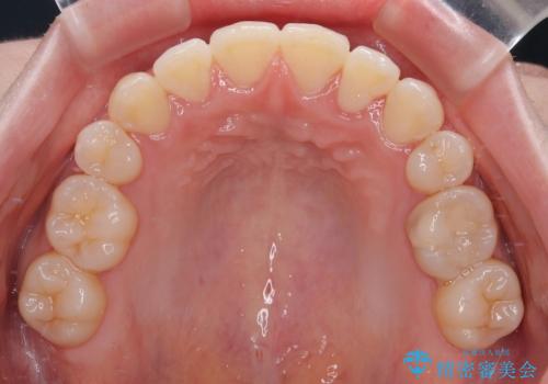 八重歯が気になる。補助装置を併用したワイヤー矯正の治療後