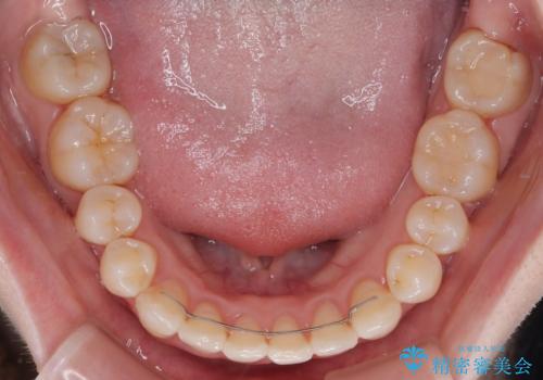 八重歯が気になる。補助装置を併用したワイヤー矯正の治療後