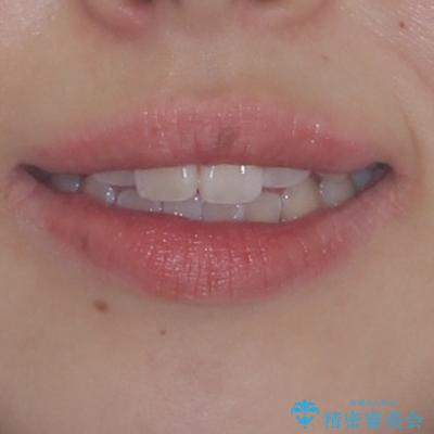 上下非接触の前歯 口元の突出感を改善する抜歯矯正の治療前(顔貌)