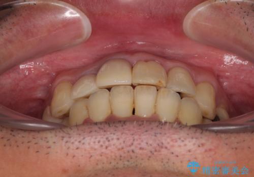 隠れている前歯 インビザライン矯正治療と前歯のセラミック治療の治療後