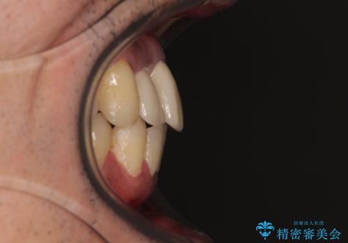 隠れている前歯 インビザライン矯正治療と前歯のセラミック治療の治療後