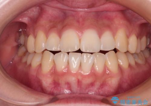 上下非接触の前歯 口元の突出感を改善する抜歯矯正の症例 治療前