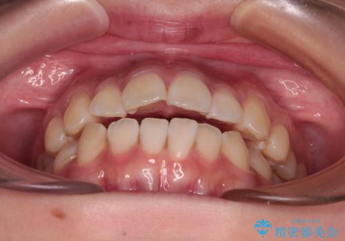 上下非接触の前歯 口元の突出感を改善する抜歯矯正の治療前