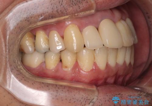 隠れている前歯 インビザライン矯正治療と前歯のセラミック治療の治療後