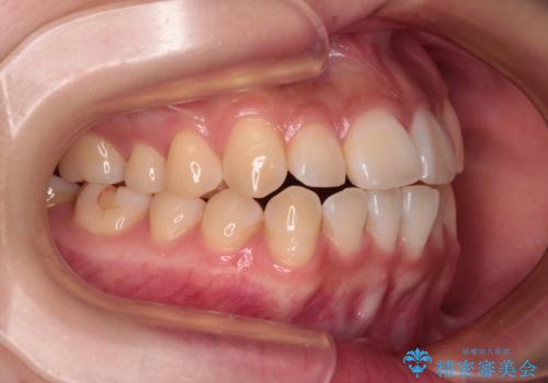 上下非接触の前歯 口元の突出感を改善する抜歯矯正の治療前