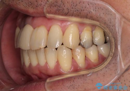 隠れている前歯 インビザライン矯正治療と前歯のセラミック治療の治療後