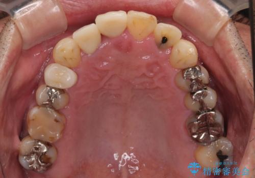 隠れている前歯 インビザライン矯正治療と前歯のセラミック治療の治療後