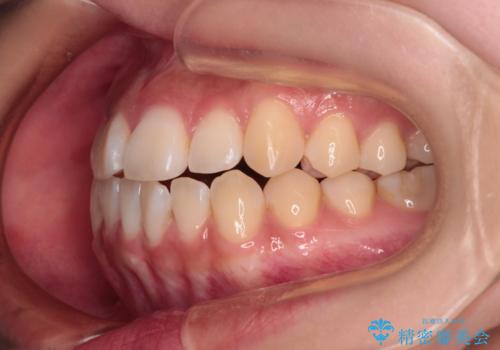 上下非接触の前歯 口元の突出感を改善する抜歯矯正の治療前