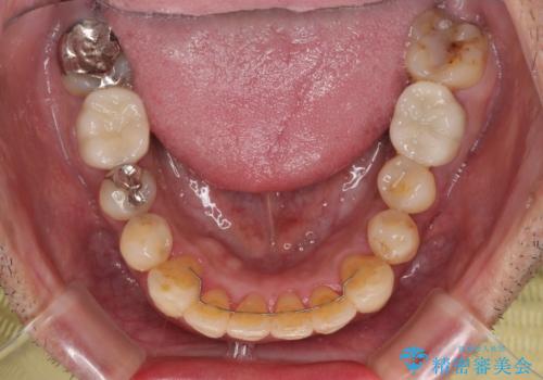 隠れている前歯 インビザライン矯正治療と前歯のセラミック治療の治療後