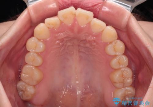 上下非接触の前歯 口元の突出感を改善する抜歯矯正の治療前