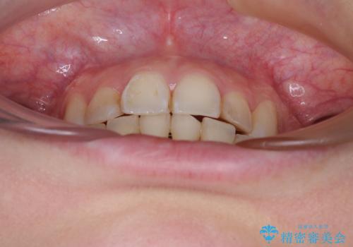 【モニター】デコボコ前歯を治したい ワイヤー装置での抜歯矯正治療の治療後