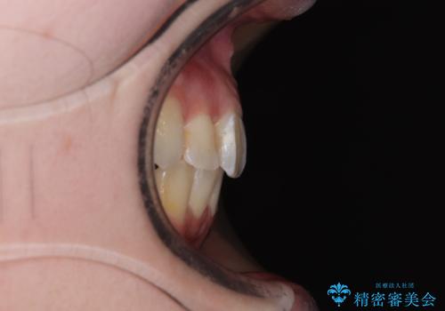 【モニター】デコボコ前歯を治したい ワイヤー装置での抜歯矯正治療の治療後