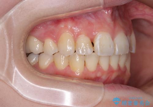 【モニター】デコボコ前歯を治したい ワイヤー装置での抜歯矯正治療の治療後