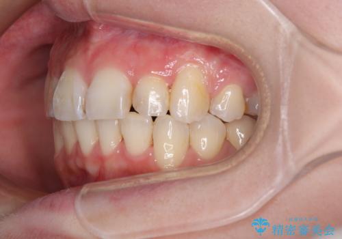 【モニター】デコボコ前歯を治したい ワイヤー装置での抜歯矯正治療の治療後