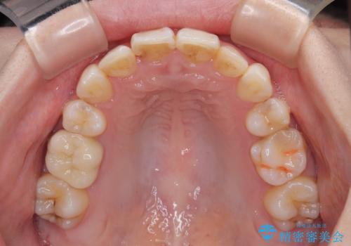 【モニター】デコボコ前歯を治したい ワイヤー装置での抜歯矯正治療の治療後