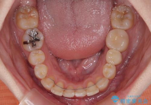 【モニター】デコボコ前歯を治したい ワイヤー装置での抜歯矯正治療の治療後