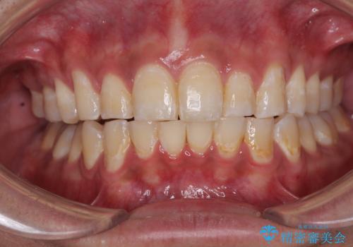 深い咬み合わせと前歯のデコボコ ワイヤー装置での抜歯矯正の症例 治療後