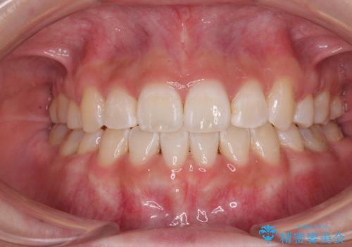 上下非接触の前歯 口元の突出感を改善する抜歯矯正の症例 治療後