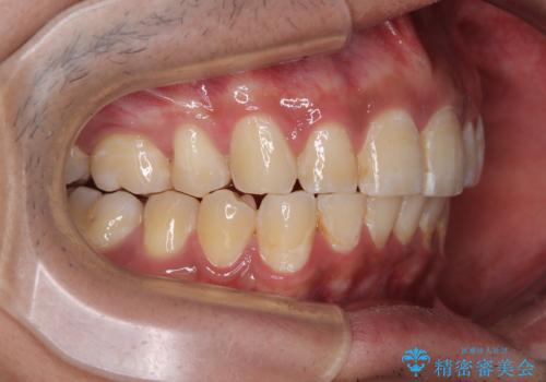 深い咬み合わせと前歯のデコボコ ワイヤー装置での抜歯矯正の治療後