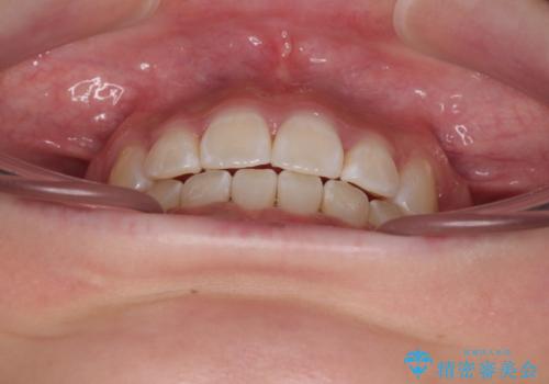 上下非接触の前歯 口元の突出感を改善する抜歯矯正の治療後