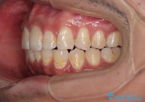 深い咬み合わせと前歯のデコボコ ワイヤー装置での抜歯矯正の治療後