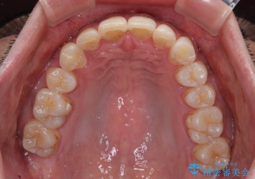 深い咬み合わせと前歯のデコボコ ワイヤー装置での抜歯矯正の治療後