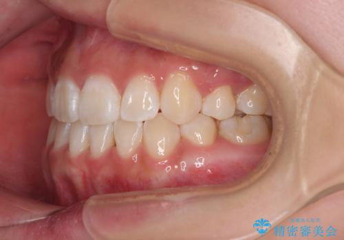 上下非接触の前歯 口元の突出感を改善する抜歯矯正の治療後
